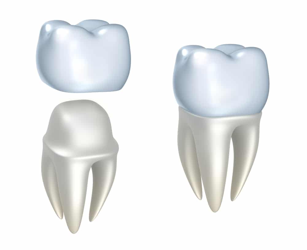 Dental Crowns & Dental Bridges Chalfont