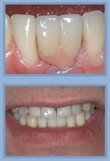 Dental Implants Lansdale