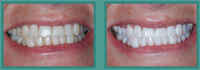 Teeth Whitening Chalfont