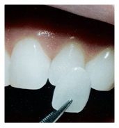 Dental crowns dentist Hatfield