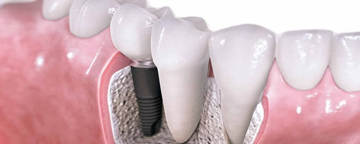 Dental Implants – Are They For Me?
